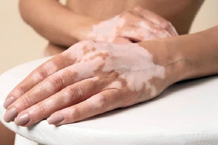 RSUD Genteng Banyuwangi Sediakan Alat Fototerapi UV untuk Penderita Vitiligo