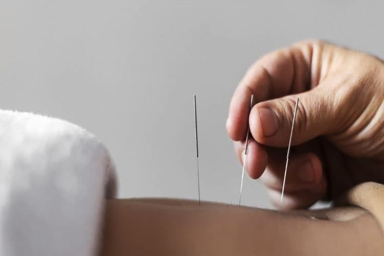 Akupunktur Estetika Wajah, Opsi Medis untuk Kulit Lebih Cerah